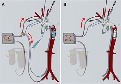 Aortic Balloon Occlusion Technique Does Not Improve Peri-Operative Outcomes for Acute Type A Acute Aortic Dissection Patients With Lower Body Malperfusion